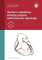 Aortos ir vainikinių arterijųjungčių suformavimo operacija