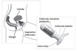 Dubens dugno raumenų stimuliacijos aparatas NeuroTrac CONTINENCE