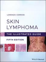 Skin Lymphoma
