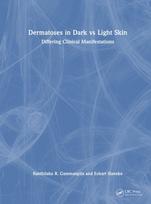 Dermatoses in Dark Vs Light Skin