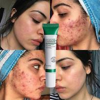 Pores Shrink Cream Moisturizing Acne Improve Acnes Blackheads Whitening Cream Anti-aging Oil Control Skin Care