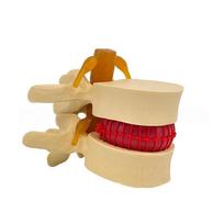 Compression Demonstration Lumbar Model 3D Model Spine Demonstration Structure  Nursing geltona