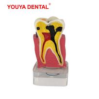 Dental Model Resin 4times Transparent Molar Anatomy Teeth Modeling With Nerves Medical Science Oral Dentist   Dentistry Products
