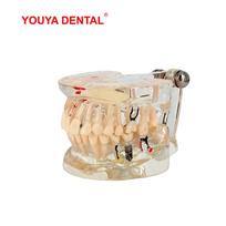 Dental Teeth Model For Studying Teaching Transparent Tooth Implant Model Adult Pathology Medical Science Oral Dentistry Products