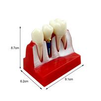 Cheap 4 Time Dental Implant Model Dentistry Resin Removable Teeth Model Analysis Crown Bridge Demostration For Teaching Studying