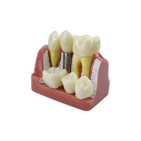 4 Times Dental Implant Teeth Model Dentistry Removable Analysis Crown Bridge Model For Studying Training Teaching Demonstration