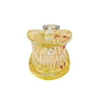Dental Teeth Model With Removal Teeth Dental Models For Patient Education Transparent Jaw Model Dentistry Pathology Typodont New
