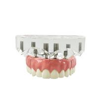 Dental Implant Model With 6 Implants Maxillary Removable Covered Denture Upper Lower Jaw For Teaching Studying Education Demo