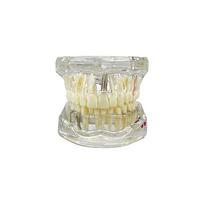Standard Dental Teeth Model Implant Disease Dentist Studying Demo Dental Typodont Model With Removable Teeth Restoration Bridge