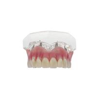 Upper Lower Dental Implant Teeth Model Clear Dental Model Teeth Implant Restoration Bridge Removable For Education Teaching Demo