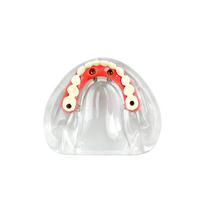 New Dental Implant Model 4 Implants Low Jaw Maryland Bridge Teeth Models Overdenture Restoration Typodont For Education Teaching