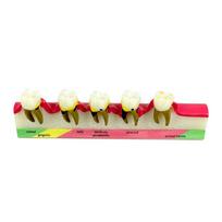 1PC Dental Periodontal Disease Model 5-Stage Perio Disease Assort Demo Typodont Caries Periodontitis Occlusal Trauma Teeth Model