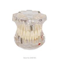 Transparent Disease Teeth Model Dental Implant Teeth Model Dentist Dental Student Learning, Teaching, Research Communication