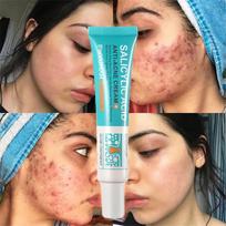 Salicylic Acid Acne Treatment Cream Deep Clean Pores Oil Control Repair Pimple Spots Moisturizer Skin Care