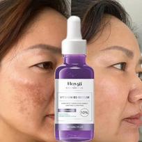 Powerful Dark Spots Remover Freckle Whitening Serum Melanin Correcting Anti Pigmentation Brightening Day Night Facial Care