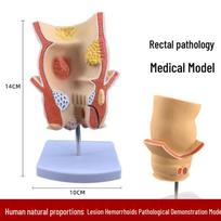 Human Large Intestine Pathological Anatomical Model: Cecum, Rectum, Duodenum