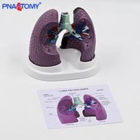 Human Lung Model: Healthy vs. Smoking Lesion for Respiratory Teaching English Guide