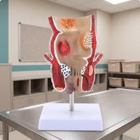 Anorectal Model with Base Hemorrhoid Enlarged for Doctors, Teachers, Training Display, 1-part