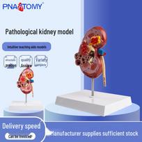 Life-Size Pathological Kidney and Adrenal Gland Model for Human Anatomy 18x14x17 cm brown