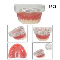 1pc Upper/Lower Dental Implant Model Jaw 2/4/6 Implants Teeth Teaching Model Dentistry Removable Study Models For Education Demo brown