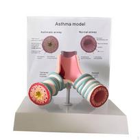 Astmos modelis su pagrindu Švietimo kvėpavimo takų palyginimas Tvirtas mokytojams Asthma Trachea gray
