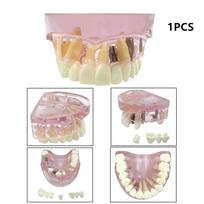 1pc Upper/Lower Dental Implant Model Jaw 2/4/6 Implants Teeth Teaching Model Dentistry Removable Study Models For Education Demo