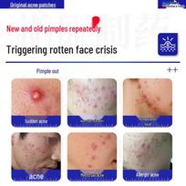 Makihara Medical Invisible Pimple Patches beige