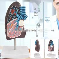 Human Pathological Lung Anatomy Model - Respiratory System 2/3 Scale
