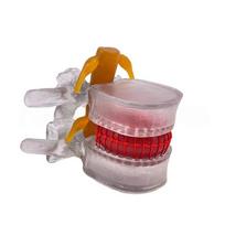 Compression Demonstration Human Anatomy Skeleton Model Spine Demonstration Structure  Traumatic