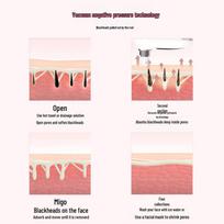 Electric Blackhead Remover with Multiple Heads - Pore Cleaner & Acne Solution for Home Use English Packaging