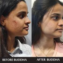Buddha Natural Anti Acne Face Wash (200 ml, Ayush Certified) - Combat, Nourish, Hydrate and Promote Clear Skin | Ideal for Oily Skin - Face Wash