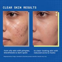 DermDoc Face Wash For Oily & Acne Prone Skin 120 ml | Helps Reduce Acne, Blackheads, Regularizes Sebum Production, Evens Skin Texture | No Parabe gryna