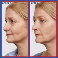 revitalift laser x3 - L'OREAL Revitalift Laser Pure Retinol Pure Retinol naktinis serumas nuo raukšlių - 30 ml. - 5 nuotrauka