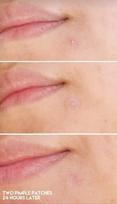 pleistrai nuo spuogu - HOLIKA HOLIKA pleistrai spuogams AC MILD RED SPOT PATCH, 12 vnt. - 2 nuotrauka