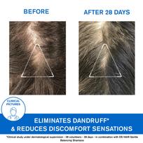 shampoo dandruff - URIAGE D.S. šampūnas nuo pleiskanų 200 ml - 2 nuotrauka