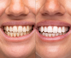 balinimo - Hismile V34 Whitening Strips dantų balinimo juostelės, 14 vnt. - 3 nuotrauka