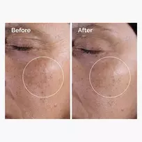 glycolic acid toner - The Ordinary Glycolic Acid 7% šveičiamasis tonikas, 100 ml - 5 nuotrauka
